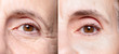 Lady eyes before and after beauty treatment
