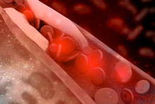 3d Rendering Blood Cells With Plaque Buildup Of Cholesterol Symbol Of Vascular Illness