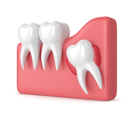 Wall Mural - 3d render of teeth with wisdom cyst