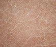texture close - up human skin with dermatological problems of dryness and cracking