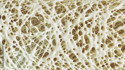 Fotografía Osteoporosis advanced -high details - Stage 4 - 3d rendering