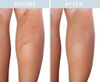 Varicose veins on the legs after and before treatment