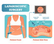 Laparoscopic surgery medical health care surgical procedure process, anatomical cross section vector illustration diagram.
