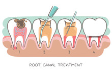 Tooth With Root Canal Treatment