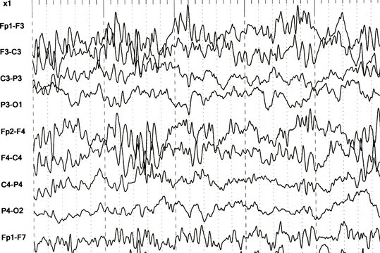 Abnormal EEG  brain wave