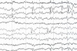 Abnormal EEG  brain wave