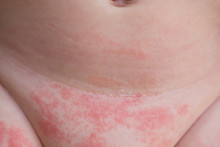 Yeast Diaper Rash And Dermatitis On The Belly Of A Newborn Baby 