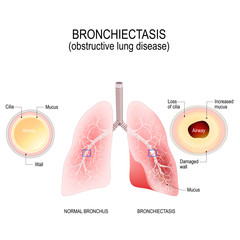 Poster - Normal bronchus and bronchiectasis. obstructive lung disease