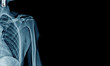 © angkhan - x-ray shoulder and part of rib and lung, banner x-ray