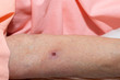 Scab. A wound form a scab on an arm of elderly patient.