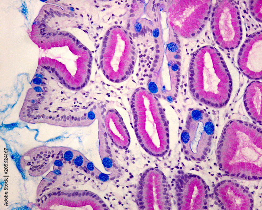 Intestinal metaplasia of gastric mucosa Stock Photo | Adobe Stock