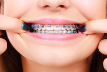Woman Showing Her Teeth With Braces