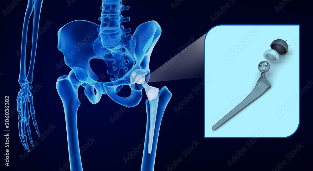 Hip replacement implant installed in the pelvis bone. X-ray view. Medically accurate 3D illustration - obrazy, fototapety, plakaty 