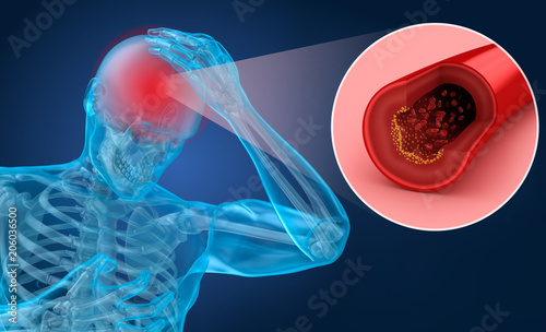 Cuadros en Lienzo Brain stroke : 3d illustration of the vessels of the brain and causes of stroke