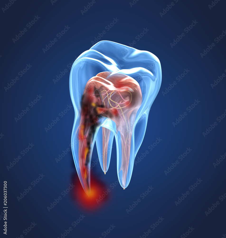 Damaged teeth xray view. Medically accurate tooth 3D illustration - obrazy, fototapety, plakaty 