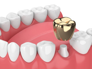 Wall Mural - 3d render of jaw with dental golden crown filling