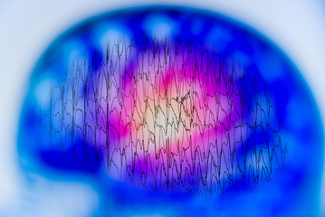 abnormal eeg brain wave