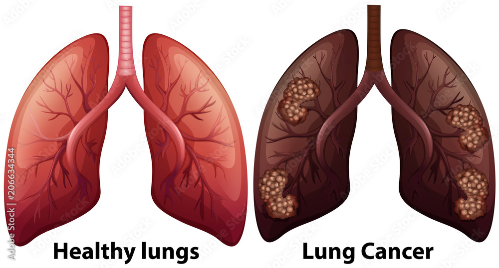 Human Anatomy of Lung Condition - obrazy, fototapety, plakaty 