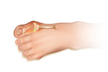 Gout.  Human Foot Illustration