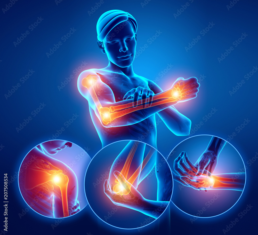 3d Illustration of Men Feeling Arm joint pain - obrazy, fototapety, plakaty 
