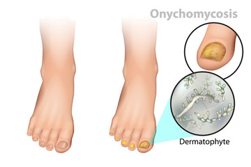 Onychomycosis or tinea unguium. Fungal nail infection. Dermatophyte