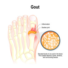 Gout Is A Form Of Inflammatory Arthritis.