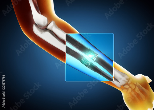 Fotografía 3d illustration of a x-ray image of a broken ulna and radius bone