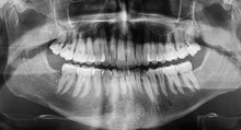 Panoramic Dental X-ray Image Of Jaw With All Teeth Showing Dental Fillings And Cavities