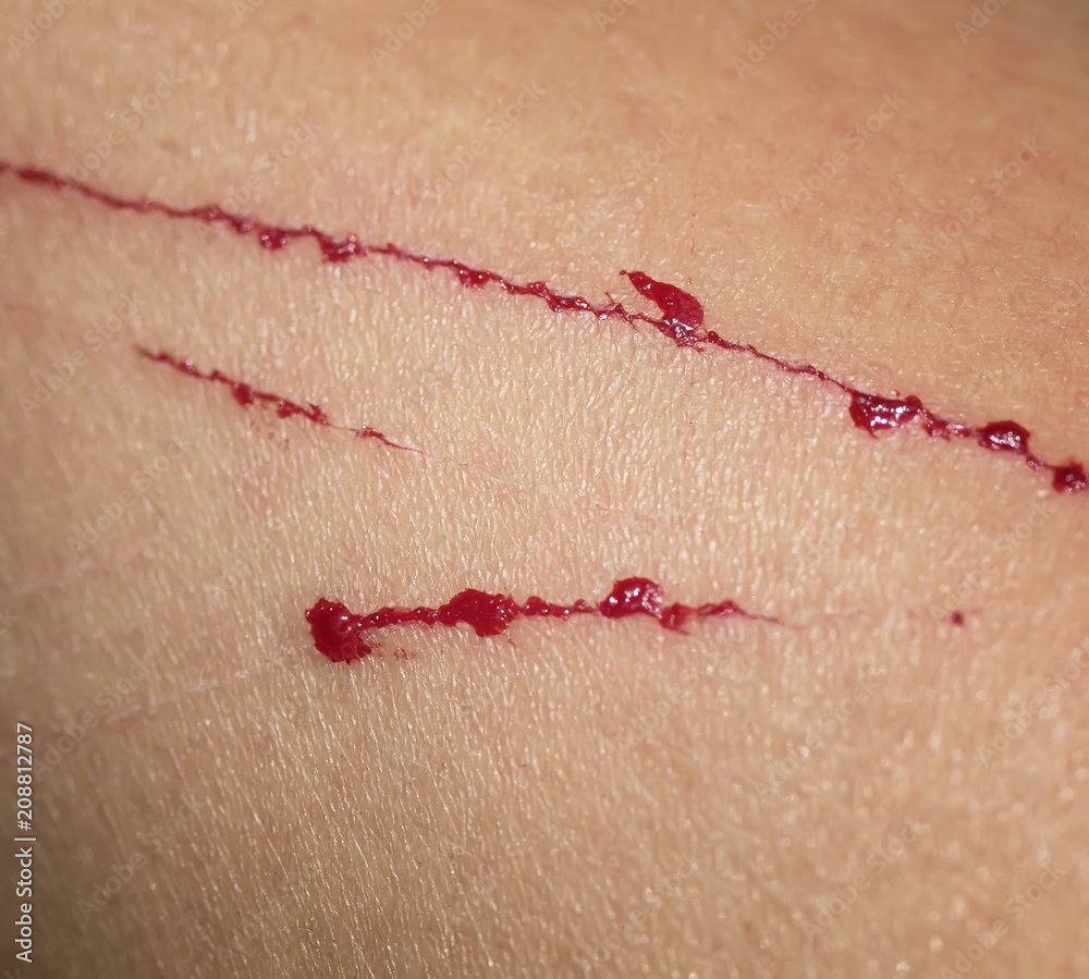 pain and itching from the wound and scratches with drops of blood on ...