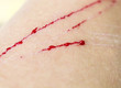 patients with deep wounds and scratches with drops of blood on human skin