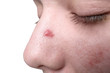 © New Africa - Young woman with acne on her face, closeup