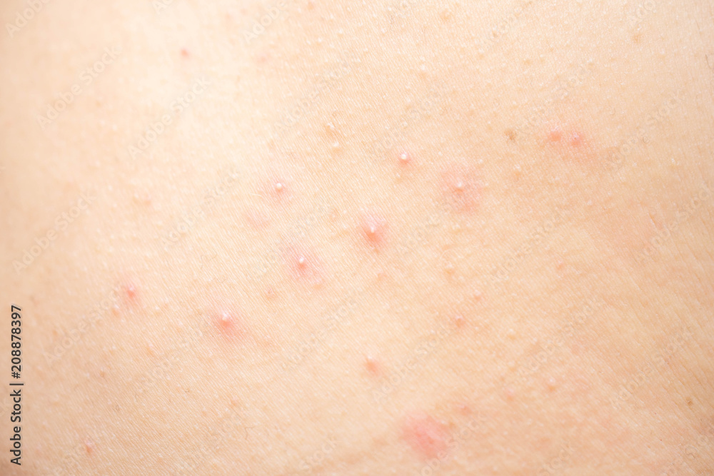 Allergic rash on the body. Stock Photo | Adobe Stock