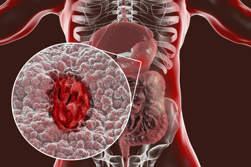 Sticker - Gastric ulcer. Mucosa of stomach with ulcer and anatomy of human digestive system. 3D illustration