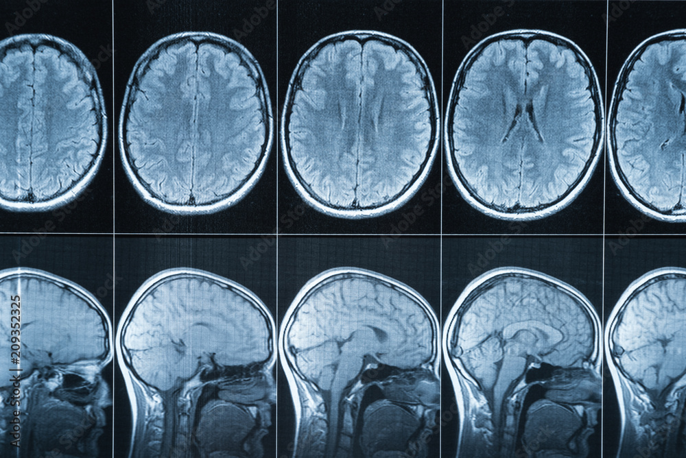 Magnetic resonance imaging of the head, MRI Stock Photo | Adobe Stock