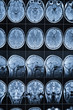 Magnetic resonance imaging of the head and brain, MRI