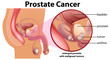 Diagram of prostate cancer