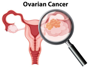 Canvas Print - Ovarian Cancer on White Background