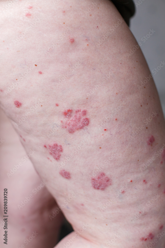 Allergic rash dermatitis eczema skin on leg of patient. Psoriasis and ...