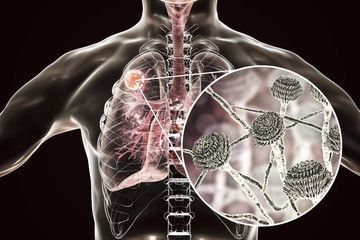 Poster - Aspergilloma of the lung and close-up view of Aspergillus fungi, 3D illustration. Also known as mycetoma, or fungus ball, a lesion produced by fungi Aspergillus in immunocompromised patients