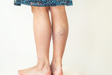 Examination of varicose veins on the womans legs