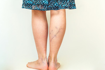 Examination of varicose veins on the womans legs