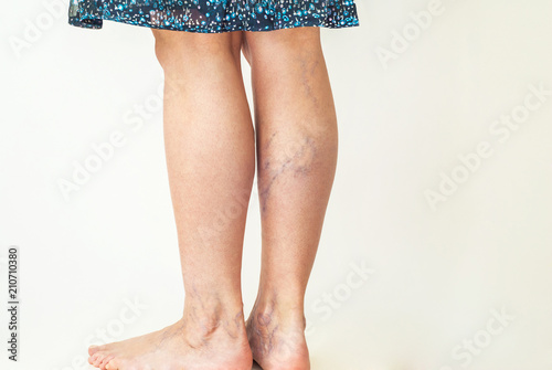 Fotografía Examination of varicose veins on the womans legs