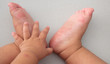 Hand, foot and mouth disease of kid