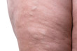© staras - Varicose veins closeup, fat female legs