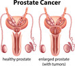 Comparison of Healthy and Cancer Prostate