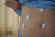 An abdomen of adult Asian female patient with Waterproof Transparent Dressing after Cholecystectomy or Laparoscopic Gallbladder Surgery for gallstones removal.