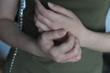 Infection in hands - scabies. Eczema symptom. Sickness hands closeup