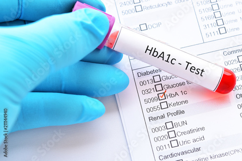 Fotografía Blood sample tube with laboratory requisition form for HbA1c test, diabetes diag