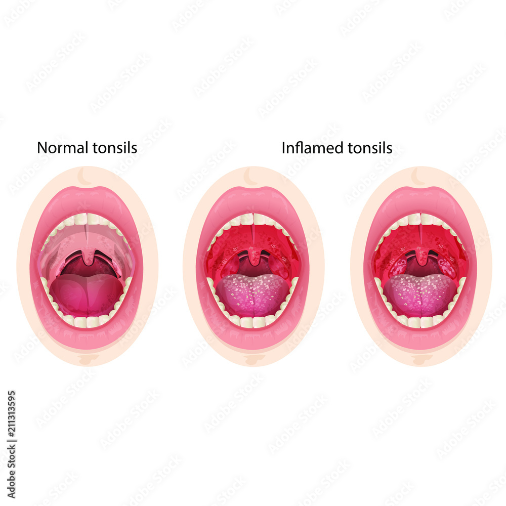 Normal and inflamed tonsils