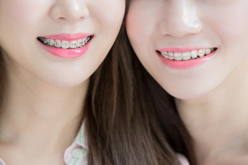 Canvas Print - close up of woman tooth